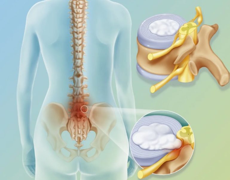 Современные подходы к лечению грыжи крестца